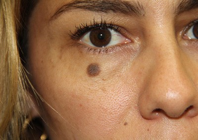 Before Image: Face Reconstruction - front
