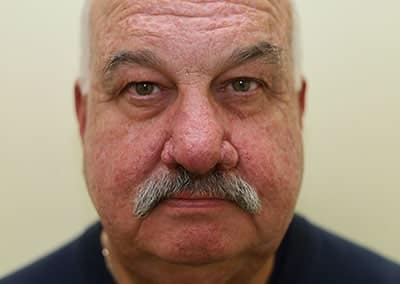 Before Image: Face Reconstruction - front