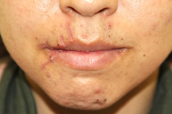 After Image: Face Reconstruction - front