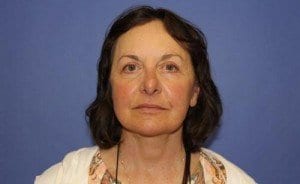 After Image: Facelift Surgery - front