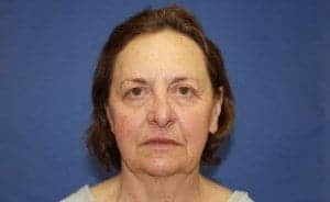 Before Image: Facelift Surgery - front