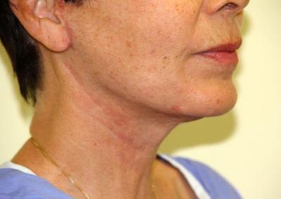 After Image: Facelift Surgery - right-front-oblique