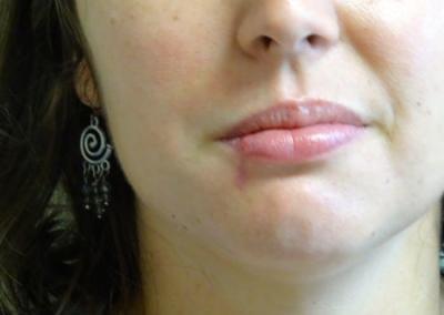 After Image: Facial Reconstruction - front