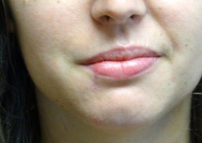 Before Image: Facial Reconstruction - front