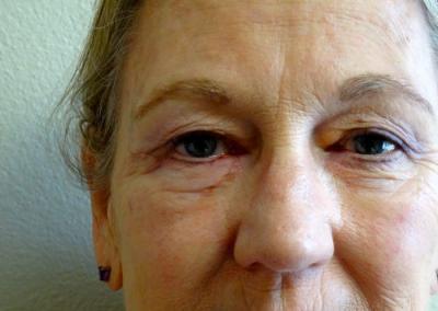 After Image: Facial Reconstruction - front