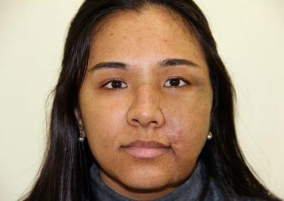 After Image: Facial Reconstruction - front
