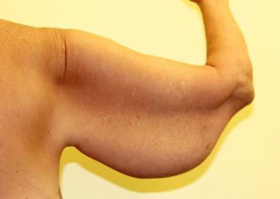 Before Image: Arm Lift - back