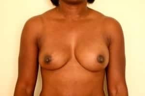 Before Image: Implant Revision - front