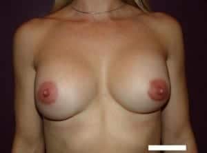 After Image: Implant Revision - front