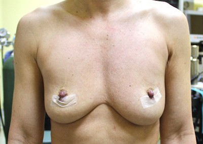 Before Image: Implant Revision - front