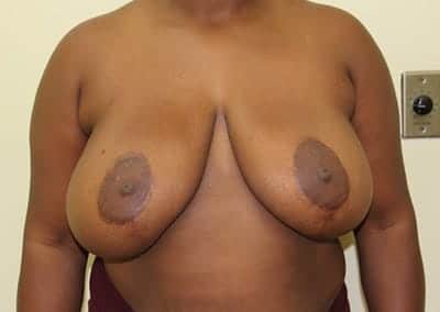Before Image: Implant Revision - front