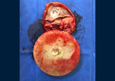 After Image: Implant Revision - front