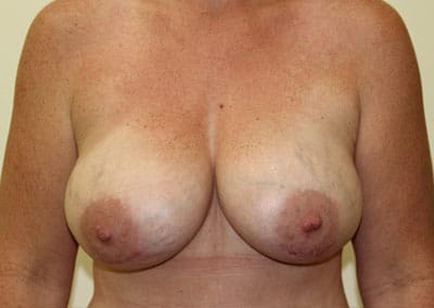 After Image: Implant Revision - front