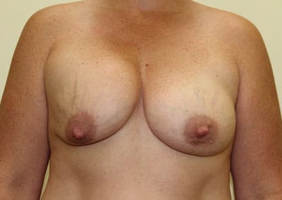 Before Image: Implant Revision - front