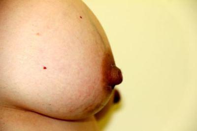 After Image: Inverted Nipple Correction - right-side