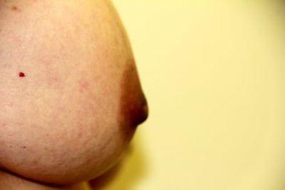 Before Image: Inverted Nipple Correction - right-side