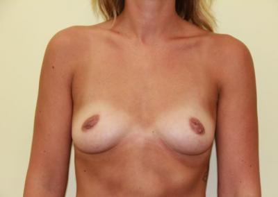 Before Image: Inverted Nipple Correction - front