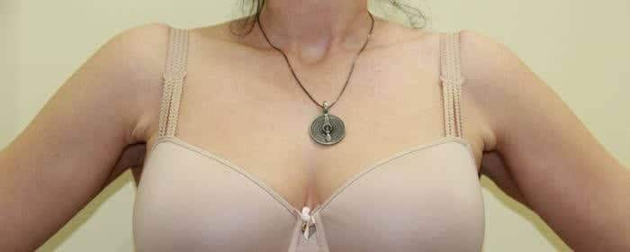 After Image: Inverted Nipple Correction - front