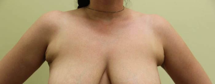 Before Image: Inverted Nipple Correction - front