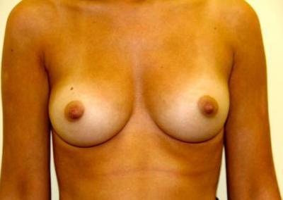 After Image: Inverted Nipple Correction - front