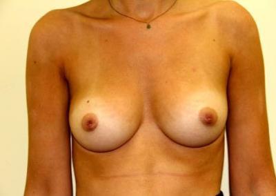Before Image: Inverted Nipple Correction - front