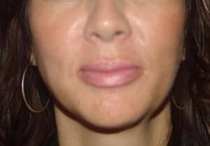 After Image: Lip Augmentation - front