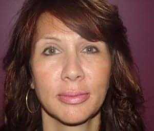 After Image: Lip Augmentation - front