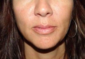 Before Image: Lip Augmentation - front