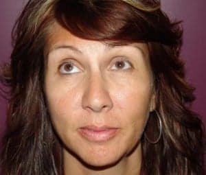Before Image: Lip Augmentation - front