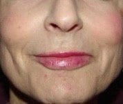 After Image: Lip Augmentation - front