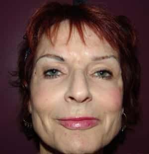After Image: Lip Augmentation - front
