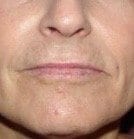 Before Image: Lip Augmentation - front