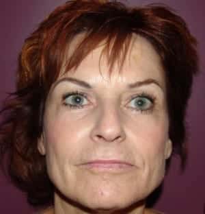 Before Image: Lip Augmentation - front