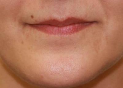 After Image: Lip Augmentation - front