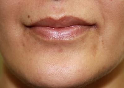 Before Image: Lip Augmentation - front