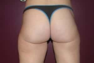 After Image: Liposuction - back