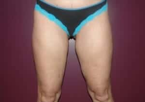 After Image: Liposuction - front