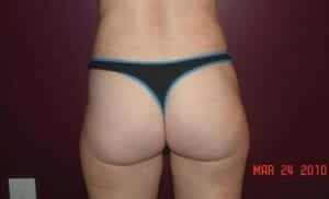 After Image: Liposuction - back