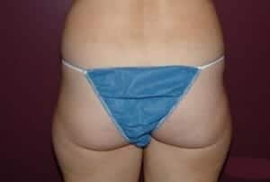 Before Image: Liposuction - back