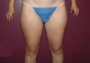 Before Image: Liposuction - front