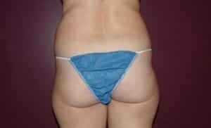 Before Image: Liposuction - back
