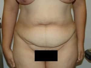 Before Image: Liposuction - front
