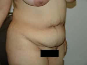 Before Image: Liposuction - right-front-oblique