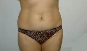Before Image: Liposuction - front