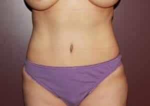 After Image: Liposuction - front