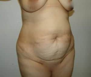 Before Image: Liposuction - right-front-oblique