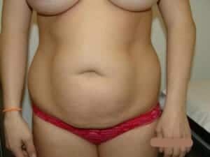 Before Image: Liposuction - front