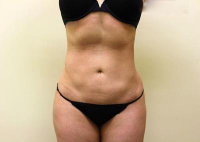 After Image: Liposuction - front