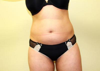 Before Image: Liposuction - front