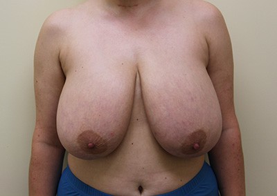 Before Image: Liposuction - front